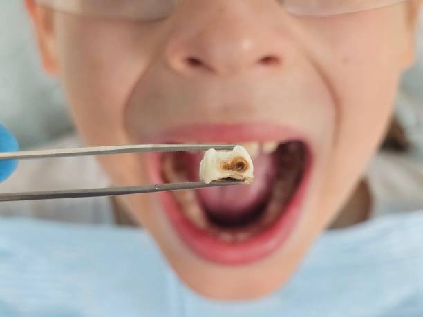 Best Emergency Root Canal Treatment in Black River Falls, WI